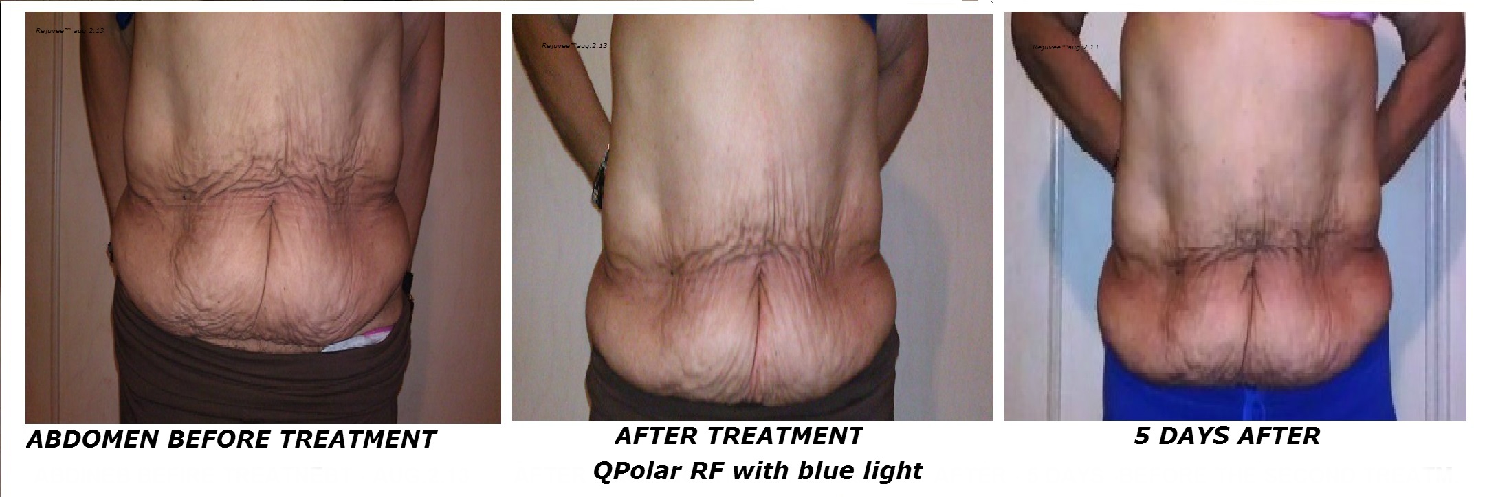  Before and After the treatment QPolar RF 