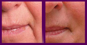 MESOTHERAPY RF -Face