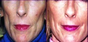 mesotherapy face 2