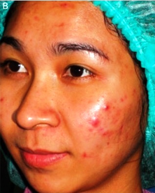 PDT-Acne-Therapy