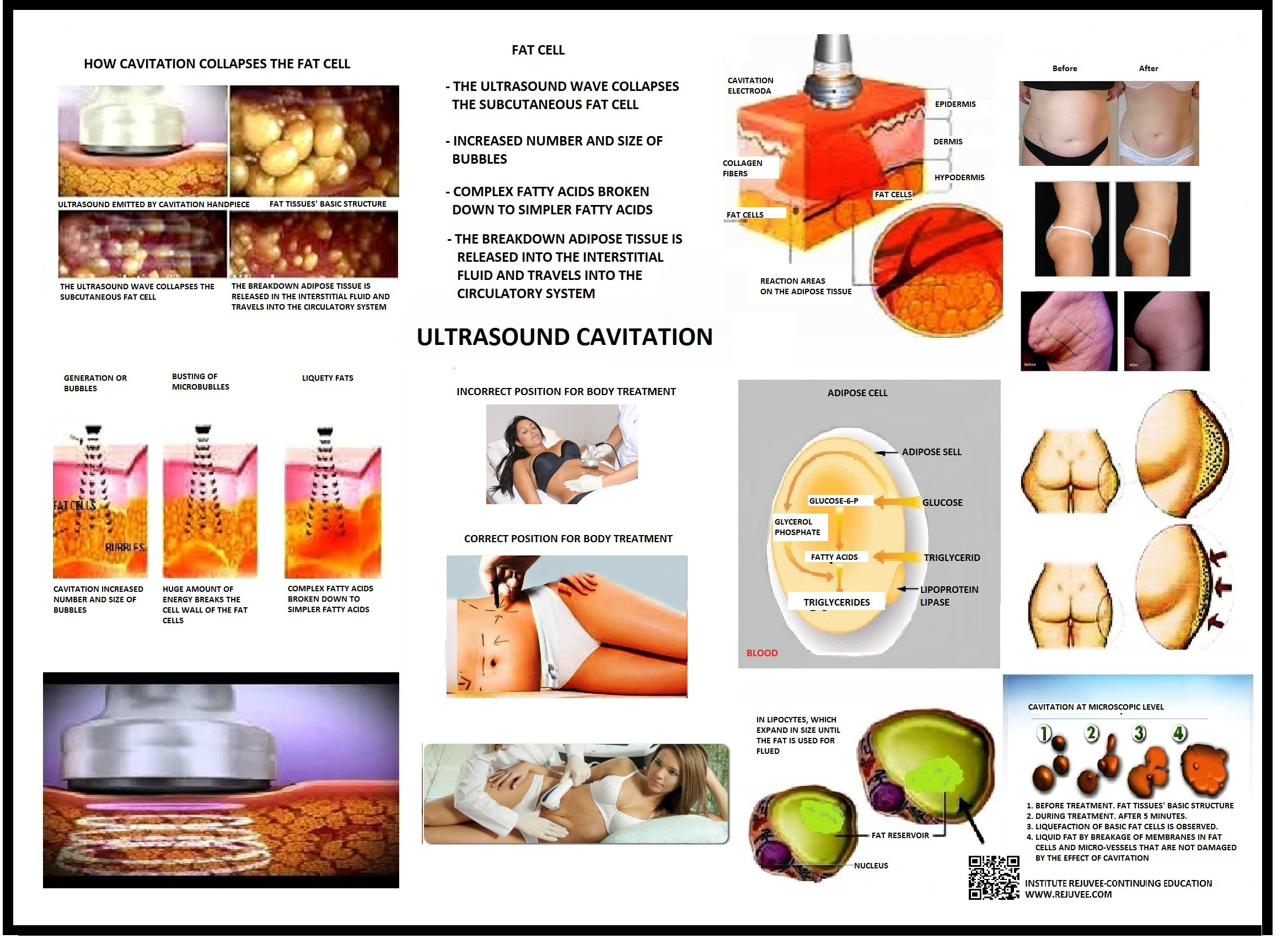 POSTER: ULTRASOUND CAVITATION RF